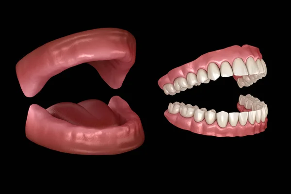 Prótesis Maxilar Mandibular Dentaduras Artificiales Ilustración Médicamente Precisa Dientes Humanos —  Fotos de Stock