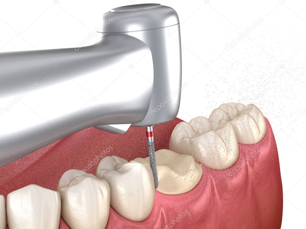 Molar preparation process for dental crown placement. Medically accurate 3D illustration
