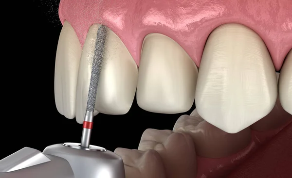 Zentraler Schneidezahnpräparationsprozess Für Die Platzierung Von Veneers Medizinisch Korrekte Darstellung — Stockfoto