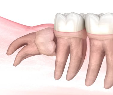 Bilgelik dişinin yatay etkisi. Tıbbi olarak doğru diş 3D illüstrasyon