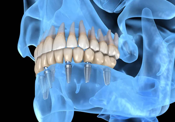 Prótesis Mandibular Todo Sistemas Soportado Por Implantes Ilustración Médicamente Precisa —  Fotos de Stock