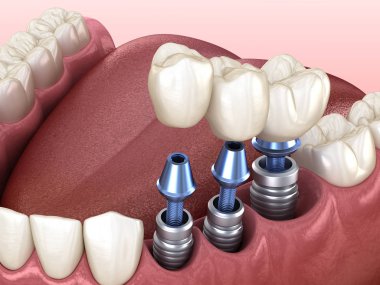 3 tooth crowns placement over 3 implants - concept. 3D illustration of human teeth and dentures clipart