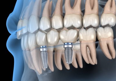Diş köprüsü implantlarla destekleniyor. İnsan dişleri ve protez kavramının tıbben doğru üç boyutlu çizimi