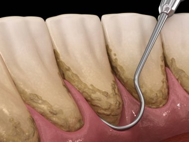Ağız temizliği: Ölçekleme ve kök planlama (geleneksel periodontal terapi). İnsan diş tedavisinin tıbbi açıdan doğru üç boyutlu çizimi