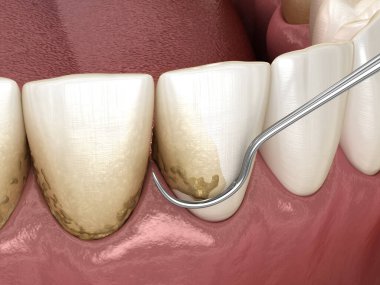 Ağız temizliği: Ölçekleme ve kök planlama (geleneksel periodontal terapi). İnsan diş tedavisinin tıbbi açıdan doğru üç boyutlu çizimi