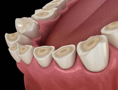 Diş çürümesi (Bruxism) diş dokusunun kaybıyla sonuçlanır. Tıbbi olarak doğru diş 3D illüstrasyon