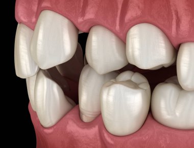 Anormal diş pozisyonu, ortodontik kavram. Tıbbi olarak doğru diş 3d illüstrasyon