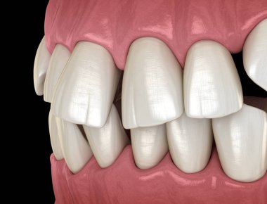Anormal diş pozisyonu, ortodontik kavram. Tıbbi olarak doğru diş 3d illüstrasyon