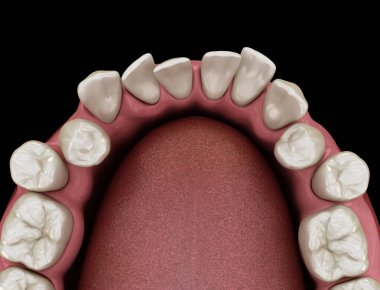 Anormal diş pozisyonu, ortodontik kavram. Tıbbi olarak doğru diş 3d illüstrasyon