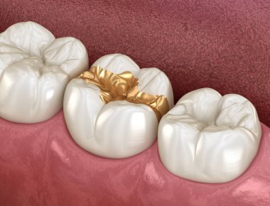 Altın Kalık taç diş üzerinde fiksasyon. İnsan diş tedavisi tıbbi olarak doğru 3d illüstrasyon