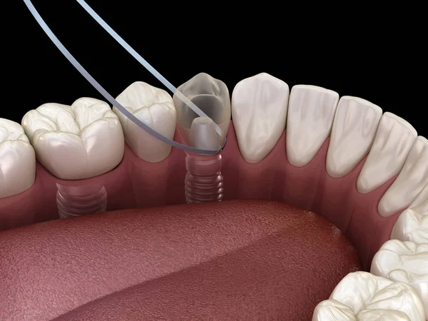 Czyszczenie Zęba Implantu Nici Dentystycznej Medycznie Dokładna Ilustracja — Zdjęcie stockowe