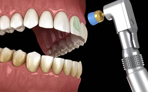 用专业的刷子和胶水刷牙 医学上准确的3D图像 — 图库照片