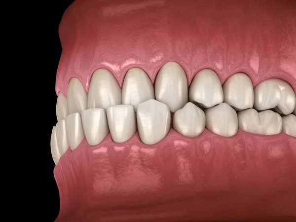 Underbite Diş Tıkanıklığı Dişlerin Maloklüzyon Tıbbi Olarak Doğru Diş Illüstrasyon — Stok fotoğraf