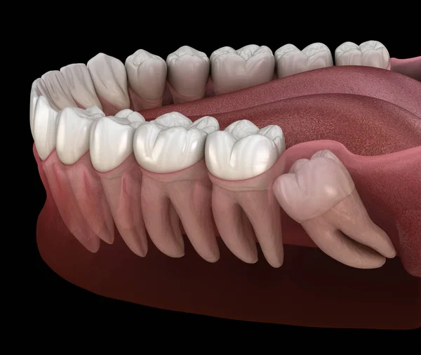 Dente Sábio Com Impacto Dente Molar Ilustração Dente Medicamente Precisa — Fotografia de Stock