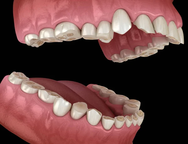 Tandutmattning Bruxism Resulterar Förlust Tandvävnad Medicinskt Korrekt Tand Illustration — Stockfoto