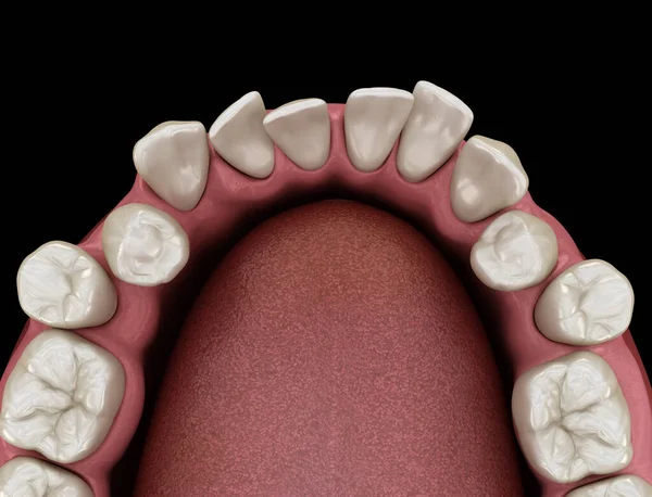 Posição Anormal Dos Dentes Conceito Ortodôntico Ilustração Dente Medicamente Precisa — Fotografia de Stock