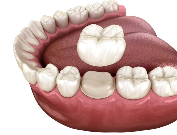 Dent Molaire Préparée Pour Placement Couronne Dentaire Illustration Médicalement Précise — Photo