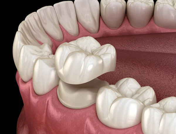 Dente Molare Preparato Posizionamento Della Corona Dentale Illustrazione Clinicamente Accurata — Foto Stock