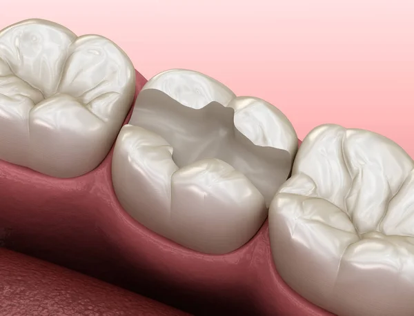 用于镶嵌放置的齿准备 人体牙齿治疗的医学精确三维插图 — 图库照片
