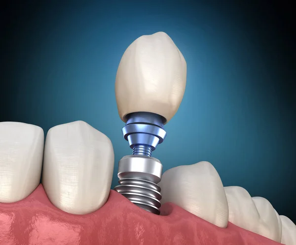 Recuperación Dental Preremolar Con Implante Ilustración Médicamente Precisa Del Concepto —  Fotos de Stock