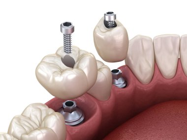 Azı dişi ve azı dişi yerleştirme implantın üzerine, vida saplantısı. Diş tedavisinin 3B illüstrasyonu