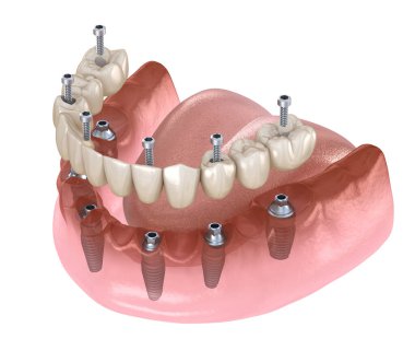 Alt çene protezi. Hepsi de implantlar ve vida saplantısıyla desteklenen 4 sistemde. Diş konseptinin tıbben doğru üç boyutlu çizimi