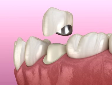 Hazırlanmış azı dişi ve diş metal seramik kaplama. Tıbbi olarak doğru 3d illüstrasyon