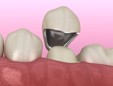 Hazırlanmış azı dişi ve diş metal seramik kaplama. Tıbbi olarak doğru 3d illüstrasyon