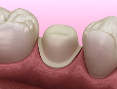 Metal-seramik diş yerleştirme için hazırlanmış azı dişi. Tıbbi olarak doğru 3B illüstrasyon