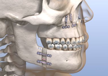 Maxillomandibular ilerlemiş ameliyat. Tıbbi olarak doğru olan 3 boyutlu diş illüstrasyonu.