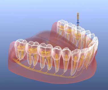 Endodontik kanal tedavisi. Tıbbi olarak doğru diş 3D illüstrasyon.