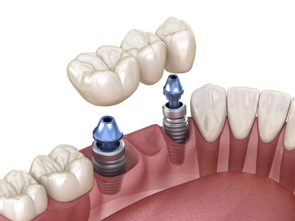 Dental bridge supported by implants. Medically accurate 3D illustration of human teeth and dentures concept