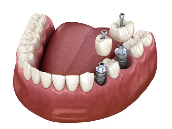 Instalación Corona Dentaria Premolar Molar Sobre Implante Fijación Tornillo Ilustración — Foto de Stock