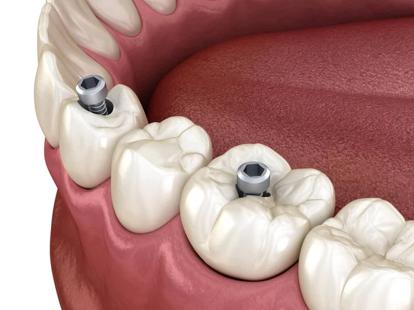 Premolaire Molaire Tand Kroon Installatie Implantaat Schroef Fixatie Illustratie Van — Stockfoto