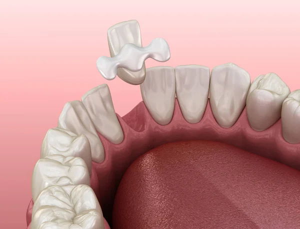 メリーランド州の橋のセラミック製 前歯の回復 歯科概念の医学的に正確な3Dイラスト — ストック写真