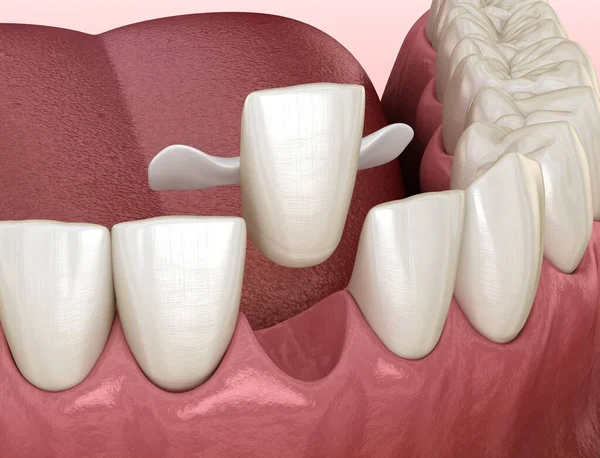 Ponte Maryland Feita Cerâmica Recuperação Dentes Frente Ilustração Medicamente Precisa — Fotografia de Stock