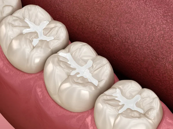 Rellenos Dentales Fisura Molar Ilustración Médicamente Precisa Del Concepto Dental — Foto de Stock