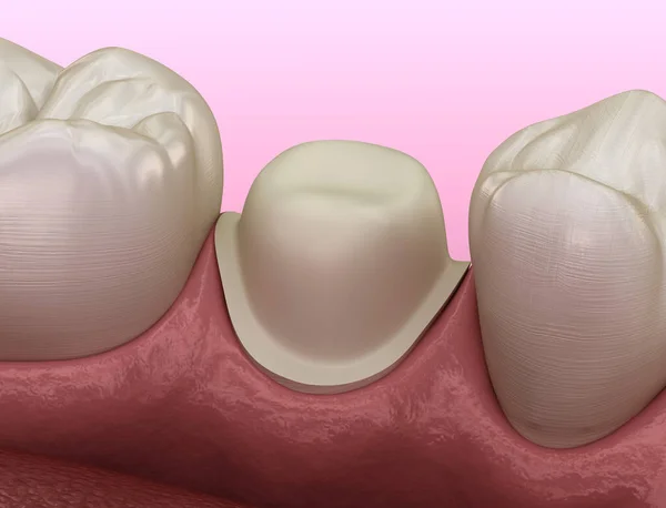Προγόμφιο Οδοντωτό Δόντι Για Τοποθέτηση Οδοντιατρικού Μετάλλου Κεραμικού Στέμματος Ιατρικά — Φωτογραφία Αρχείου
