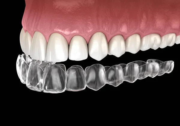 Bretelle Invisalign Fermo Invisibile Illustrazione Dentale Clinicamente Accurata — Foto Stock