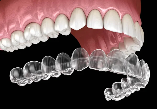 Bretelles Invisalign Dispositif Retenue Invisible Illustration Dentaire Médicalement Précise — Photo