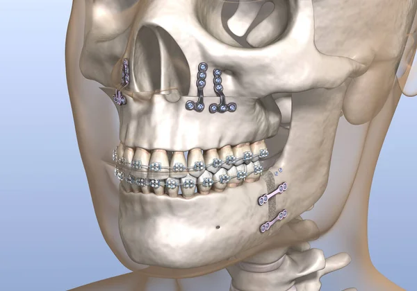 Cirurgia Avanço Maxilomandibular Ilustração Odontológica Medicamente Precisa — Fotografia de Stock