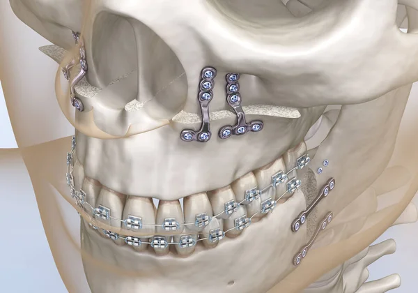 Chirurgie Maxillomandibulaire Avancement Illustration Dentaire Médicalement Précise — Photo