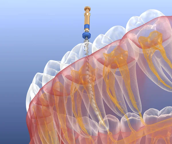 Endodontikus Gyökérkezelés Orvosilag Pontos Fog Illusztráció — Stock Fotó