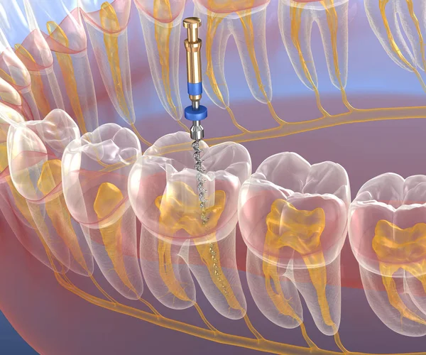 Processo Tratamento Canal Radicular Endodôntico Ilustração Dente Medicamente Precisa — Fotografia de Stock