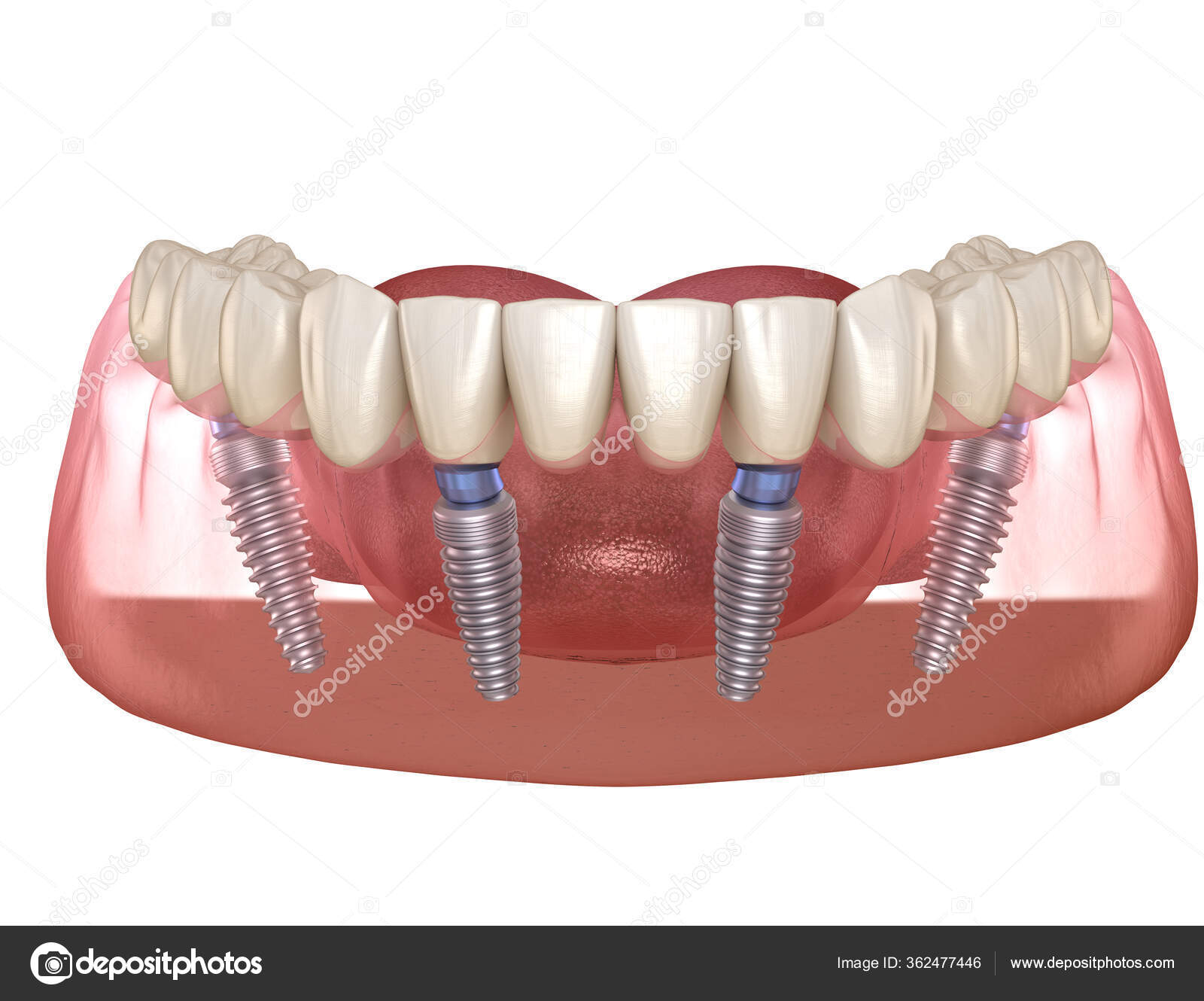 Unterkieferprothese Alles Auf System Das Durch Implantate Unterstützt