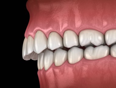 Overbite dental occlusion ( Malocclusion of teeth ). Medically accurate tooth 3D illustration clipart
