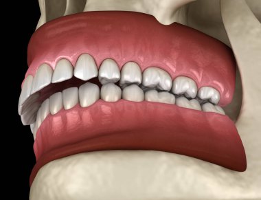 Overbite diş tıkanıklığı ( Diş maloklüzyonu ). Tıbbi olarak doğru diş 3d illüstrasyon