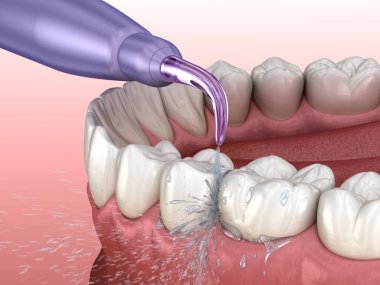 Tahriş edici, su dişleri temizliği. Ağız hijyeni tıbbi olarak doğru 3d illüstrasyon.