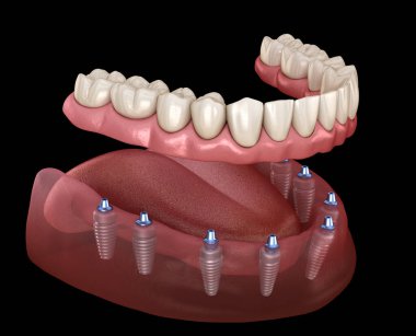 Mandibular protez Tüm 8 sistemi implantlar tarafından desteklenir. İnsan dişleri ve protezkavramının tıbbi olarak doğru 3d illüstrasyon