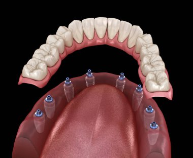 Mandibular protez Tüm 8 sistemi implantlar tarafından desteklenir. İnsan dişleri ve protezkavramının tıbbi olarak doğru 3d illüstrasyon